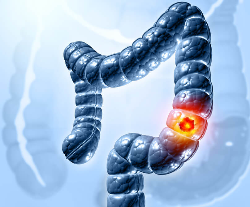Καρκίνος του παχέος εντέρου: Ποια συμπτώματα προειδοποιούν;