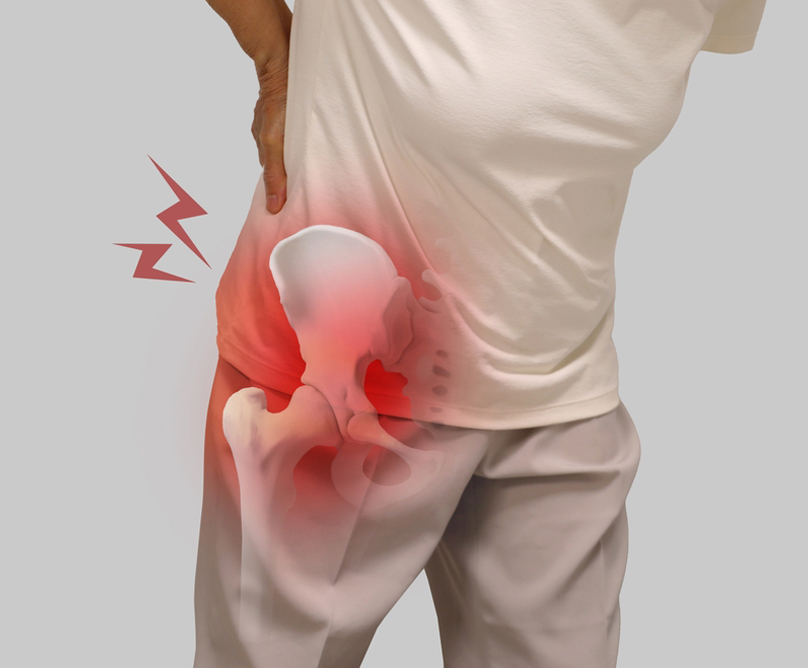 Ταυτόχρονη Ολική Αρθροπλαστική Ισχίου με την ελάχιστα επεμβατική μέθοδο ASI