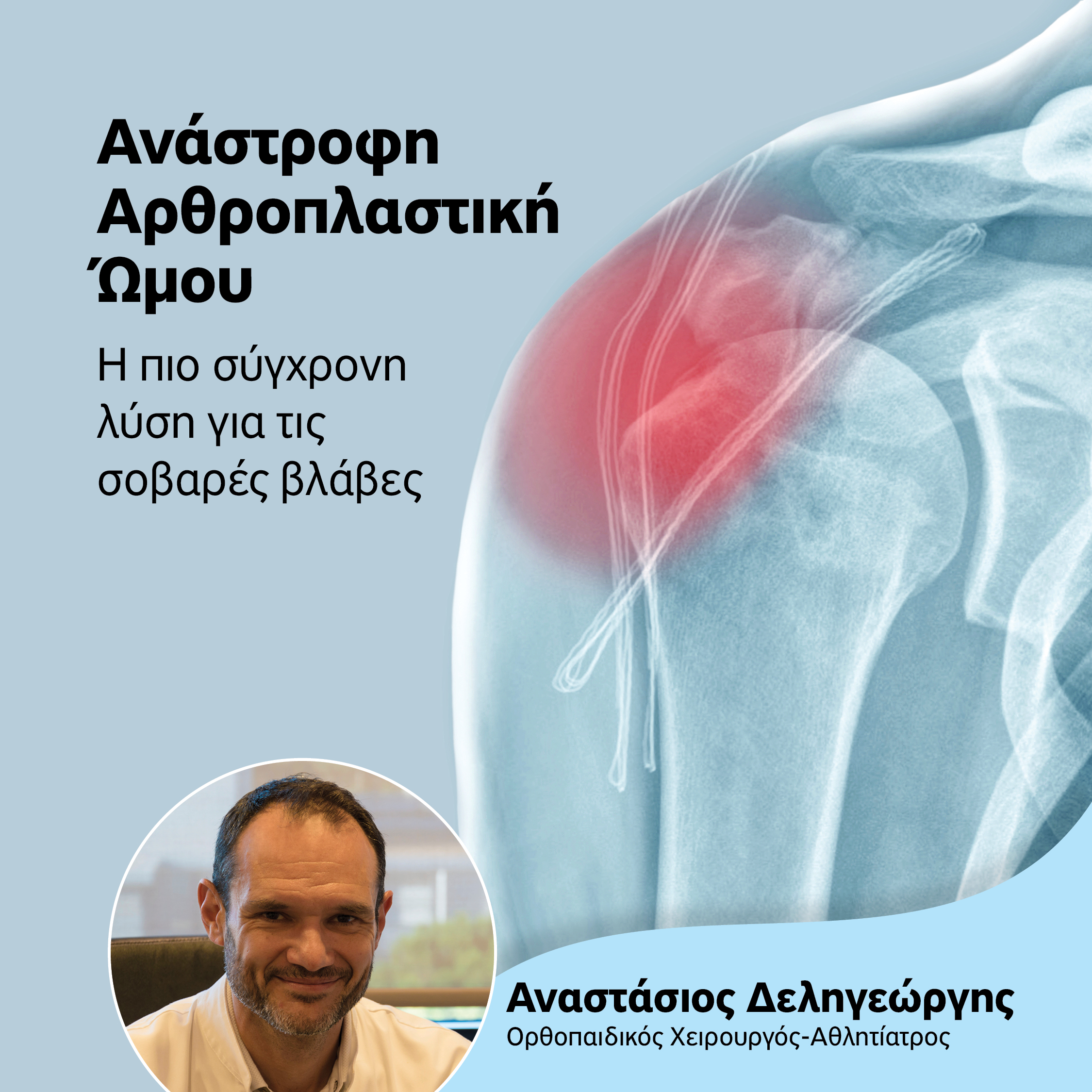 Ανάστροφη Αρθροπλαστική Ώμου: Σύγχρονη λύση για πολύπλοκα προβλήματα