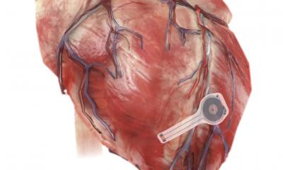 Δημιουργήθηκε ο πρώτος στον κόσμο προσωρινός, βιοδιασπώμενος στο σώμα και ασύρματος βηματοδότης καρδιάς