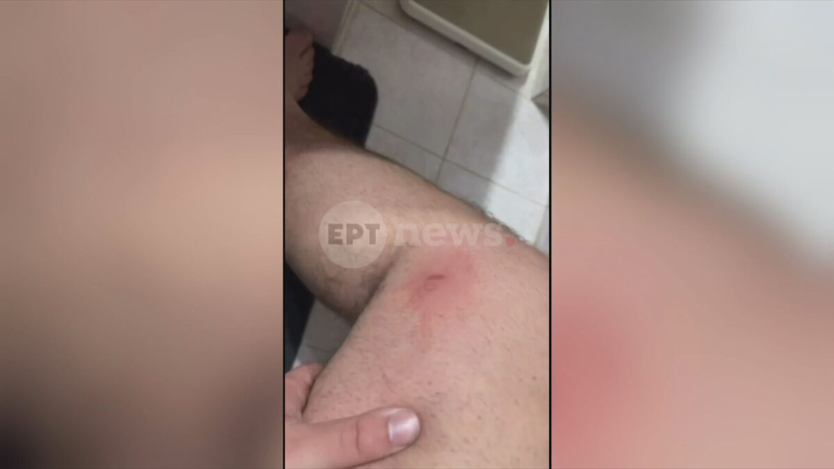 Αίγιο: Με σκάγια από φυσίγγια για κυνήγι μεγάλων θηραμάτων πυροβόλησε τους ανήλικους ο 46χρονος – Αποκλειστικές φωτογραφίες των τραυμάτων