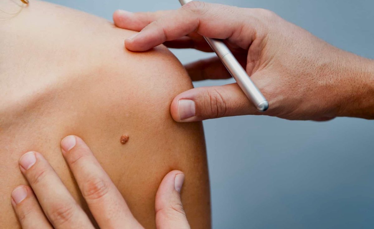 Διεθνής έρευνα αποκαλύπτει: Σχεδόν 4 στους 10 καρκίνους παγκοσμίως θα μπορούσαν να είχαν προληφθεί