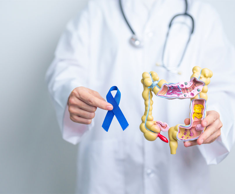 Καρκίνος παχέος εντέρου: Γιατί αυξάνεται στα άτομα κάτω των 50;